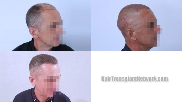 Hair transplantation procedure before and after results