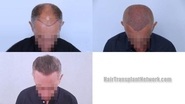 Hair transplantation surgery before and after images