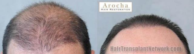 Hair restoration procedure before and after results