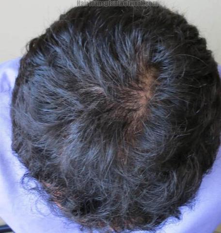 Hair transplantation surgery before and after images