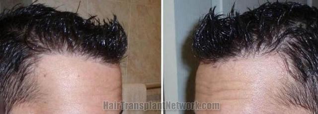 Hair transplantation surgery before and after pictures