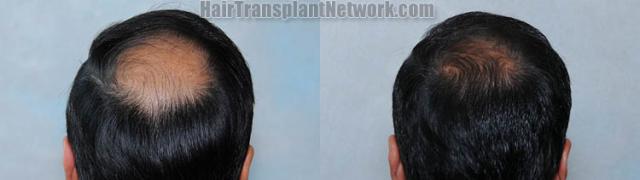 Hair replacement surgery before and after images