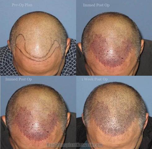 Top view - Before and after surgical hair replacement