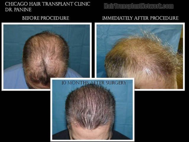 Hair transplantation surgery before and after photos