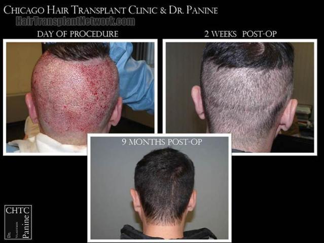 Hair restoration procedure before and after pictures