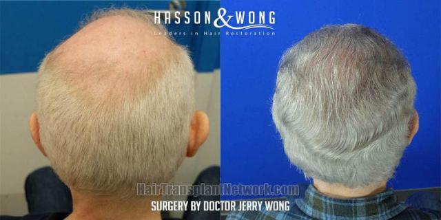 Hair replacement surgery before and after images