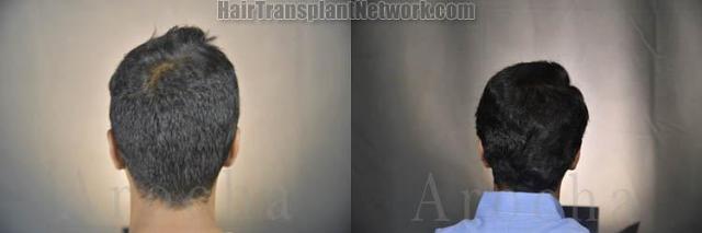 Surgical hair transplantation result photographs