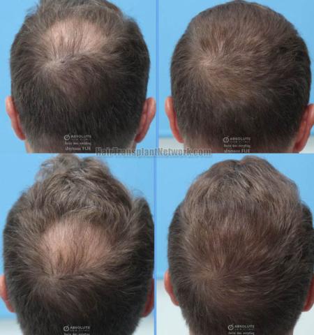 Hair replacement surgery before and after images