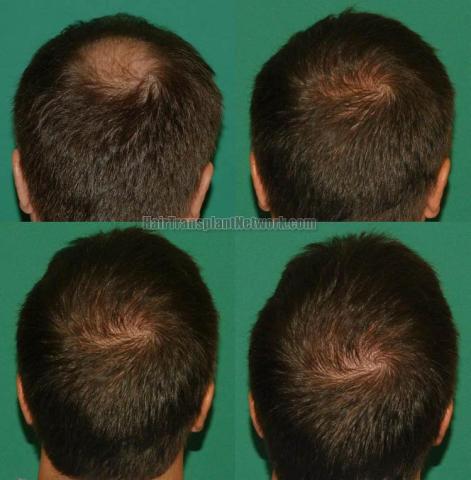 Hair restoration procedure before and after results