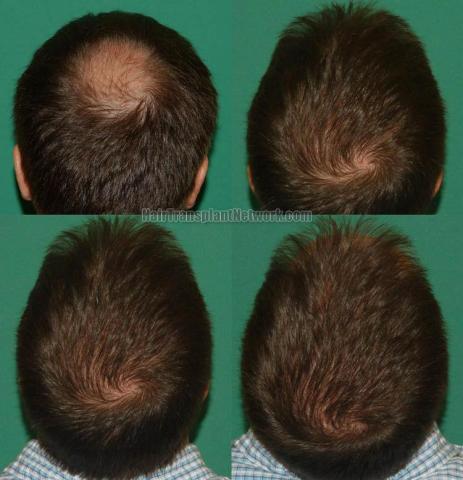 Hair transplantation surgery before and after photos