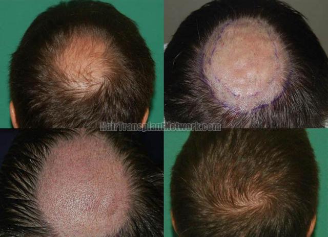 Hair transplantation surgery before and after images