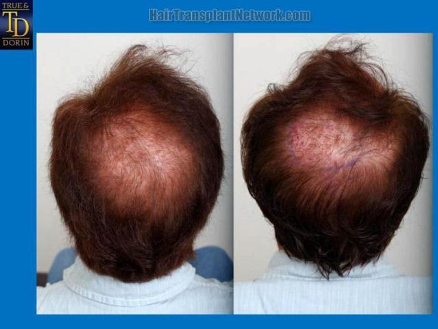 Hair restoration procedure before and after pictures