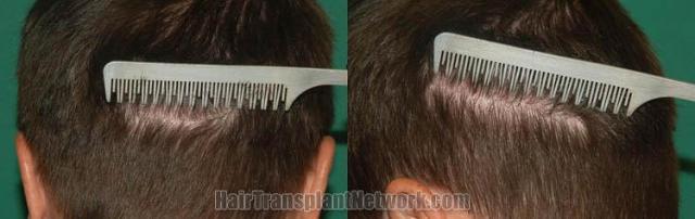 Hair transplantation surgery before and after pictures