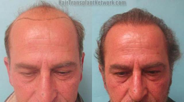 Hair restoration procedure before and after results