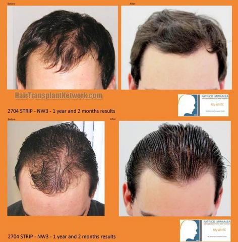 Hair restoration procedure before and after results