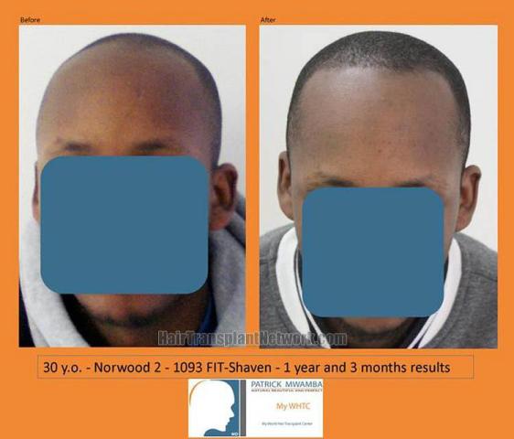 Hair restoration procedure before and after results