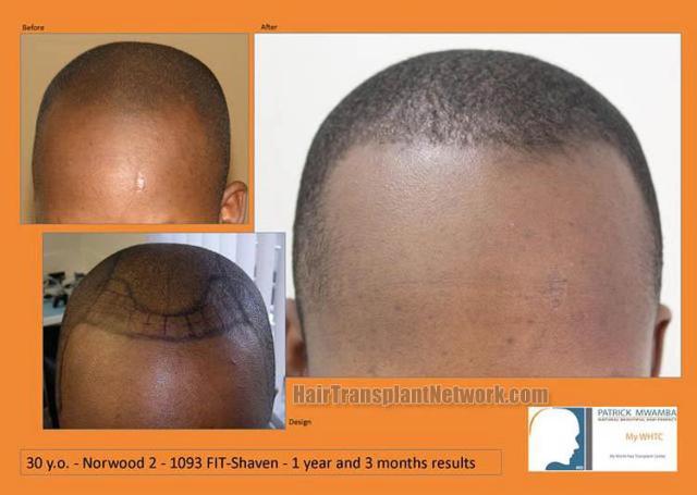 Hair restoration procedure before and after pictures