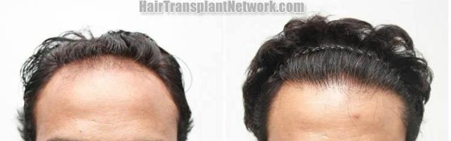 Hair restoration procedure before and after results