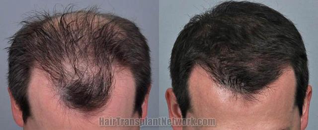 Hair restoration procedure before and after results