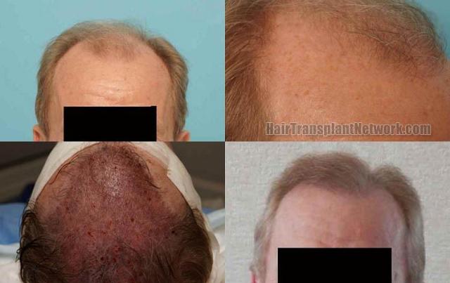 Hair restoration procedure before and after results