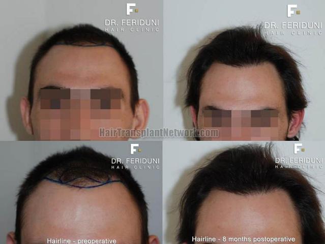 Before and after hair transplantation result photographs