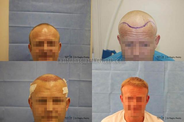 Hair transplantation surgery before and after images