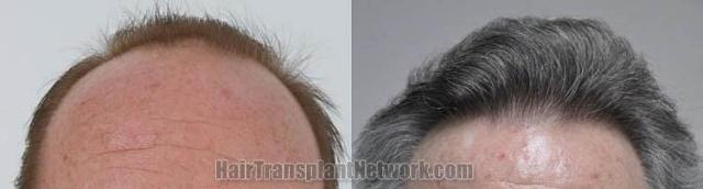 Hair restoration procedure before and after results