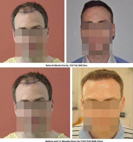 Hair restoration procedure before and after results