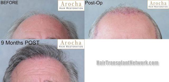 Hair transplantation surgery before and after pictures