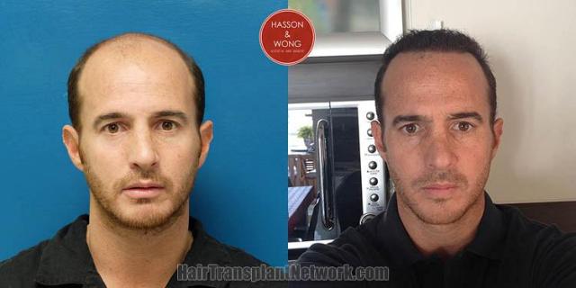 Hair restoration procedure before and after results