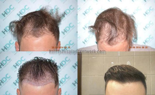 Hair restoration procedure before and after results