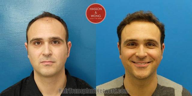 Before and after hair transplant procedure images