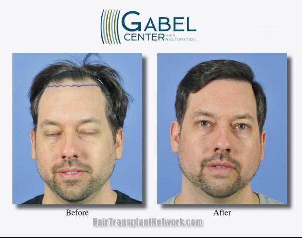 Hair restoration procedure before and after results