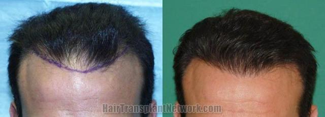 Hair restoration procedure before and after results