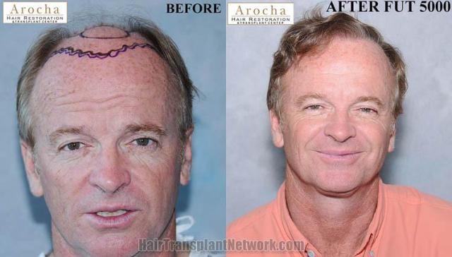 Hair restoration procedure before and after results