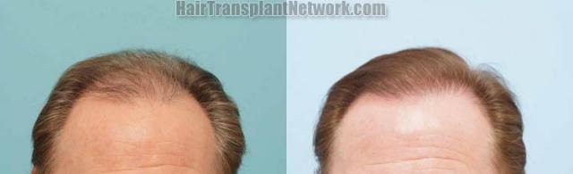 Before and after hair transplantation result photographs