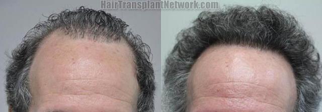 Hair restoration procedure before and after results