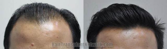 Hair restoration procedure before and after results