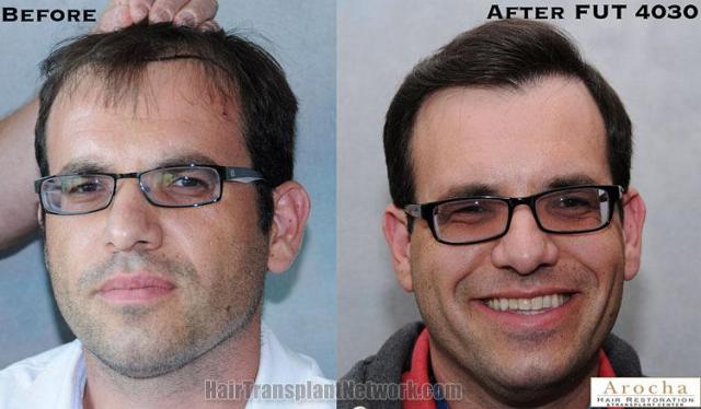 Hair restoration procedure before and after results