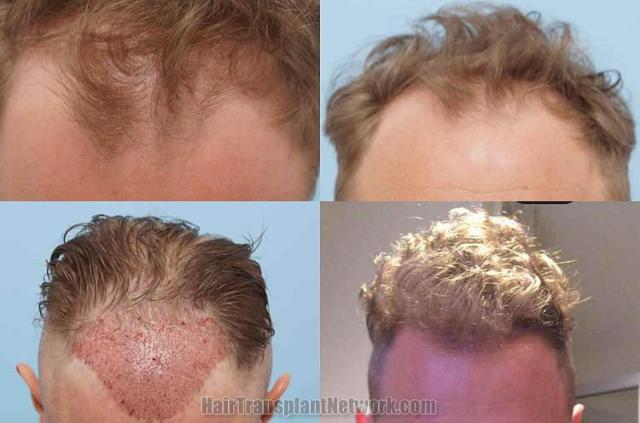 Hair restoration procedure before and after results