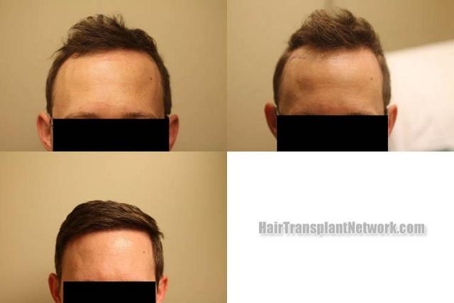 Hair restoration procedure before and after results