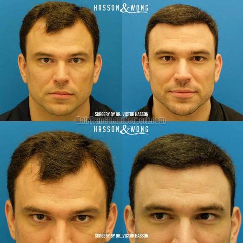 Before and after hair transplant procedure images