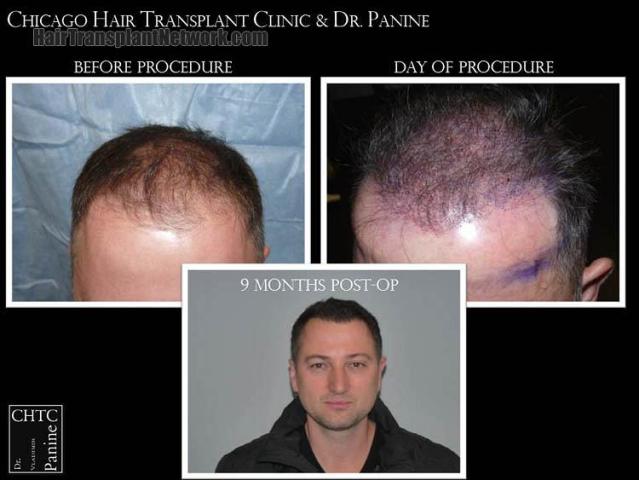 Hair restoration procedure before and after results