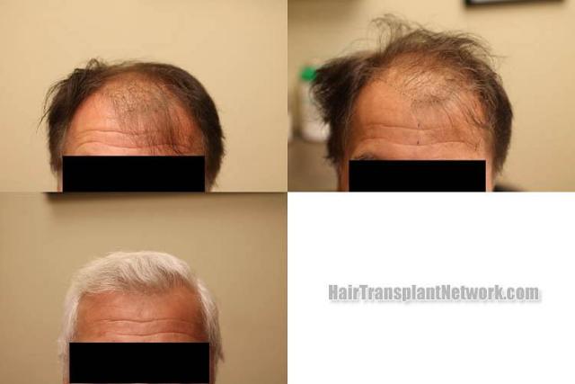 Front view - Before and after hair transplantation surgery