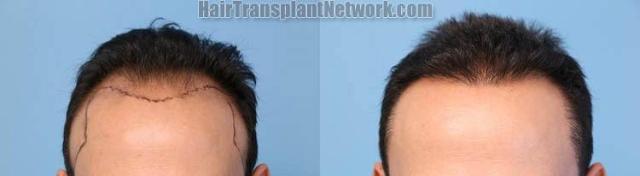 Front view - Before and after hair transplantation surgery