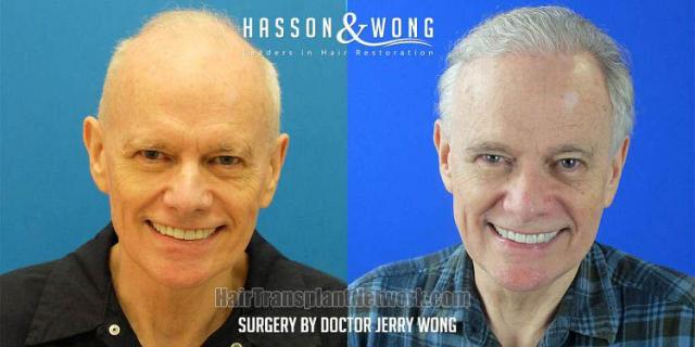 Before and after hair restoration procedure images