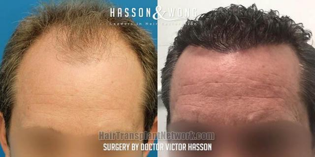 Front view - Before and after hair restoration procedure