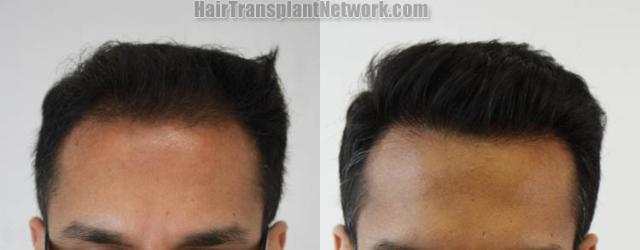 Front view - Before and after hair restoration procedure