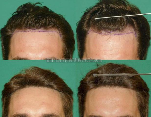 Front view - Before and after hair restoration procedure