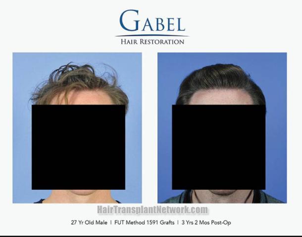 Front view - Before and after hair restoration procedure